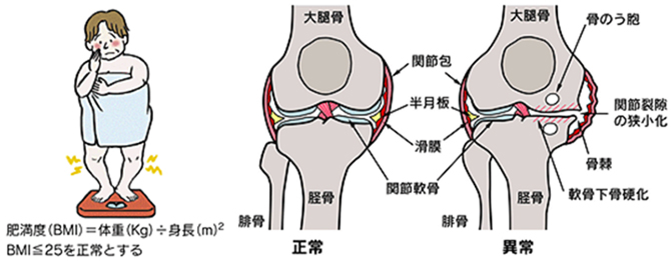 変形性膝関節症の原因イメージ