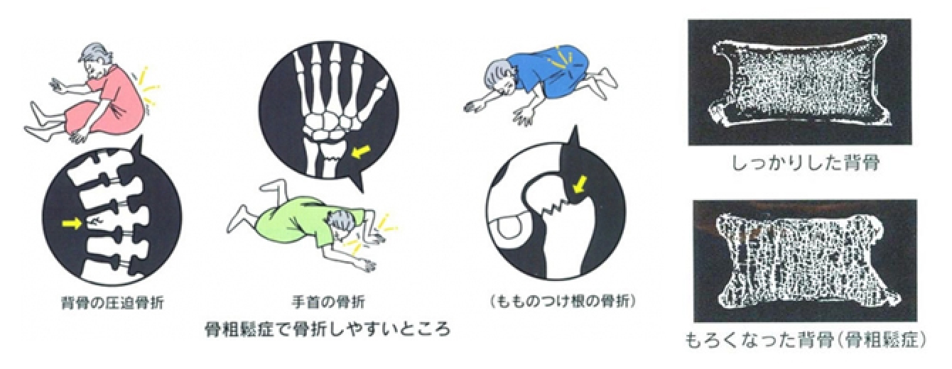 骨粗鬆症の原因のイメージ